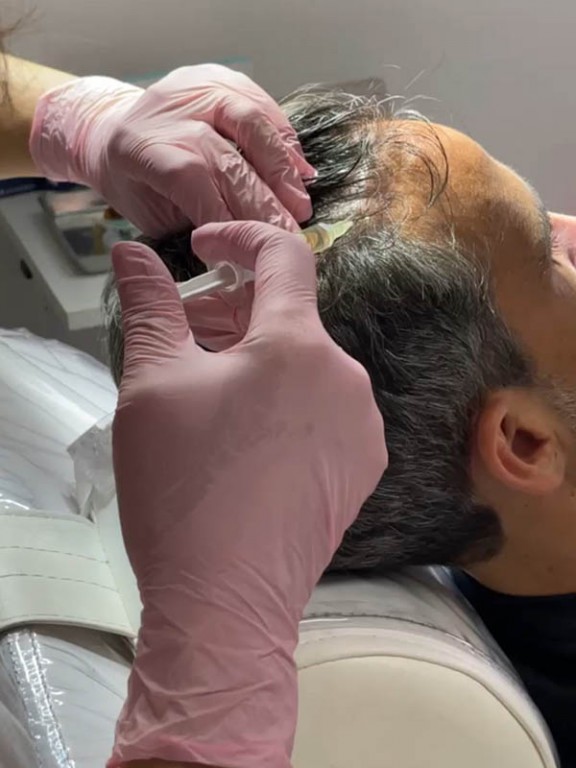 Tratamientos Capilares - Centro de Medicina Estética Regenerativa